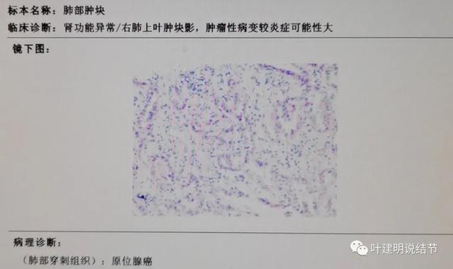 是原位腺癌 No 没有比这更典型的浸润性腺癌腺