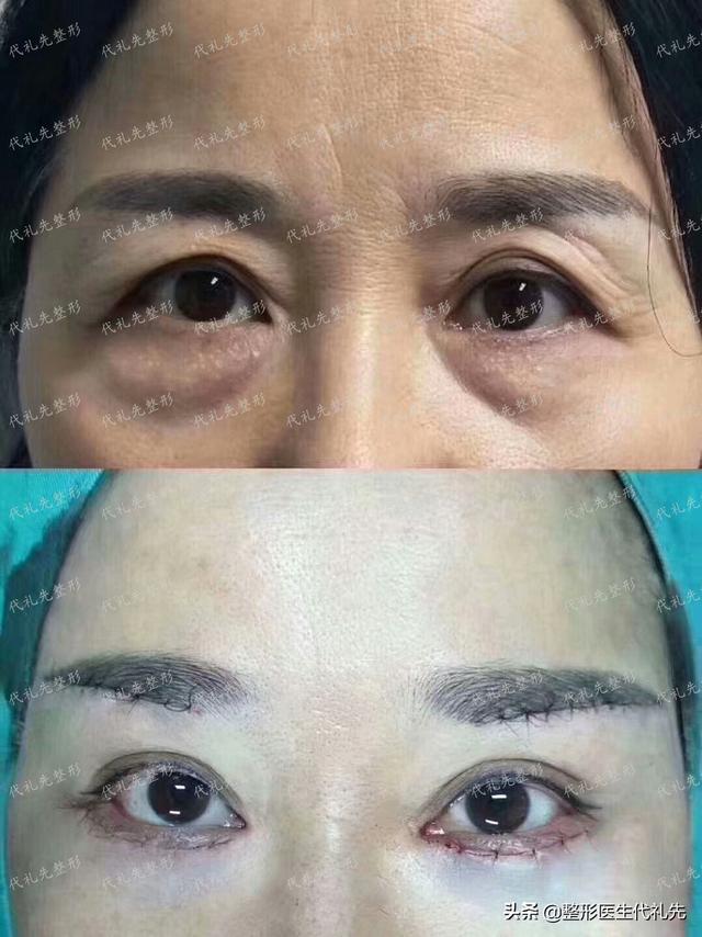 切提眉手术能解决哪些问题 上眼皮松垂怎么办 一起来
